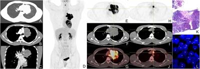 Clinical imaging of primary pulmonary nucleoprotein of the testis carcinoma
